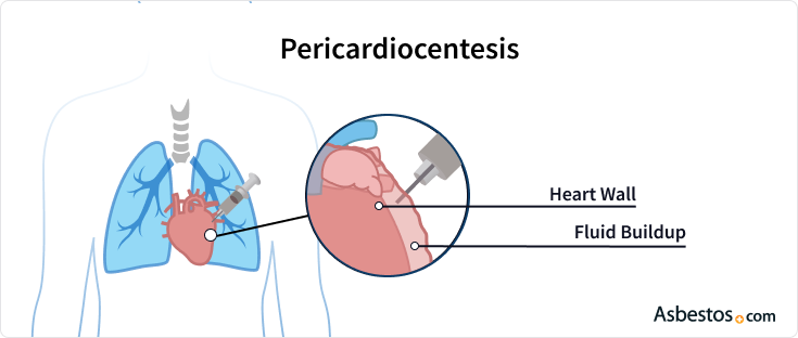 pericardiocentesis